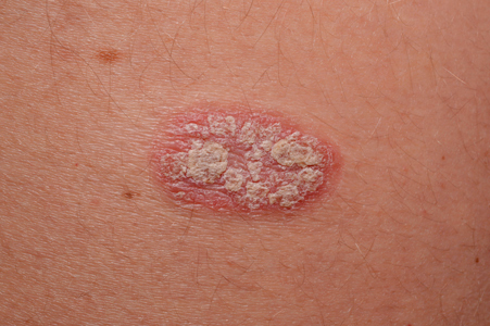 Psoriasis | KBF